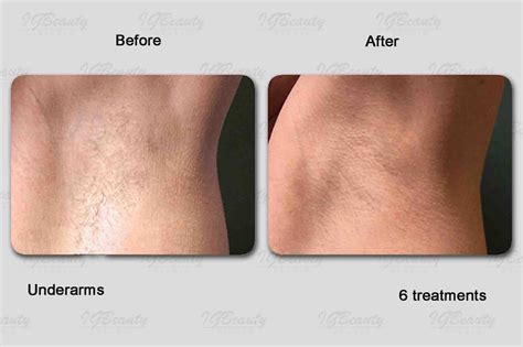 brazilian laser hair removal